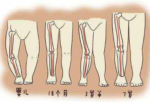 宝宝足外翻最有效的矫正按摩方法