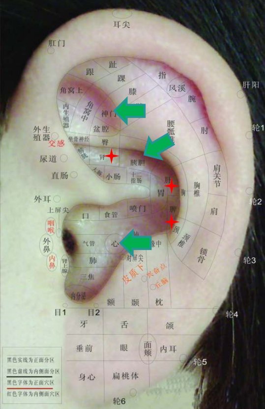 耳穴疗法治疗常见病简单易操作小方法