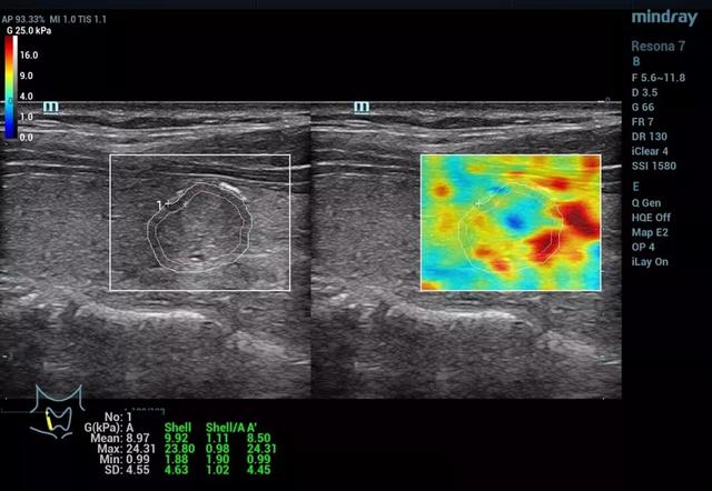 迈瑞剪切波弹性技术闪耀RSNA2018