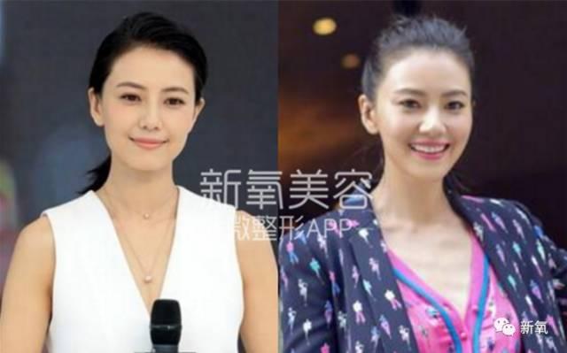 赵薇拉皮把眼睛拉飞了？！