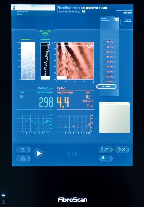 剪切波弹性成像:于细微处见真知