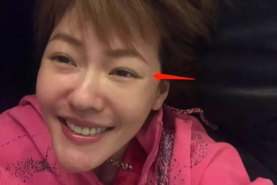 张雨绮打在腋下狐臭处的针,林允缺钱也打了脸