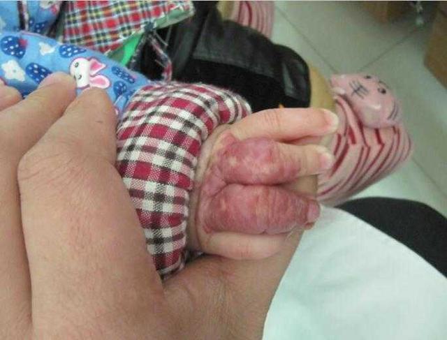 新生儿的血管瘤会出现哪些症状?医生是如何诊断血管瘤的?