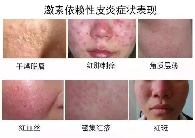 激素脸和痘痘、玫瑰痤疮有什么区别?