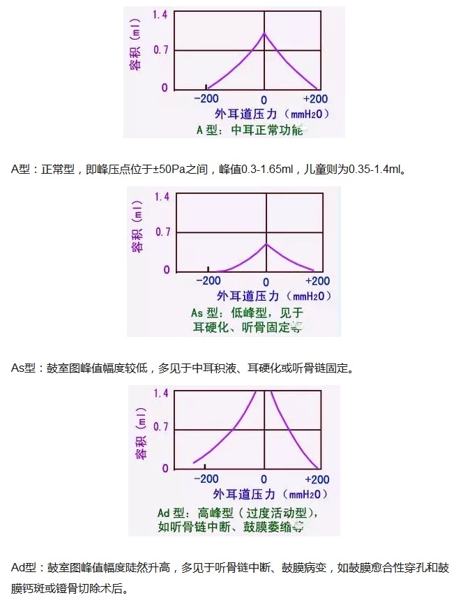 声阻抗测试 根据临床听力下降的症状,检查发现鼓膜内陷,粉红色或黄色