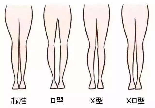 造成腿型缺陷主要是后天原因,例如疾病和营养不良, 不良的走路和站立