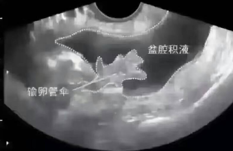 女性站立或平卧时,子宫和直肠之间的盆腔间隙(又叫后陷凹或道格拉斯