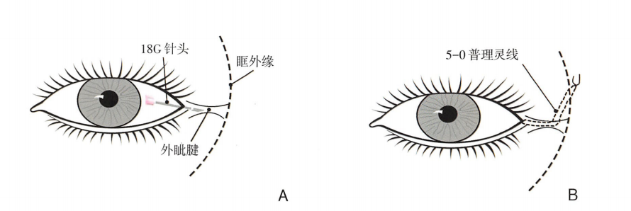 眼部整形—重睑术详细介绍