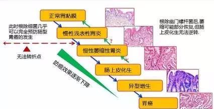 “肠上皮化生”,到底是一种什么病?真的会癌变吗?