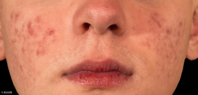 女人不想成为“痘痘脸”，建议多吃这3样，皮肤光滑又白嫩