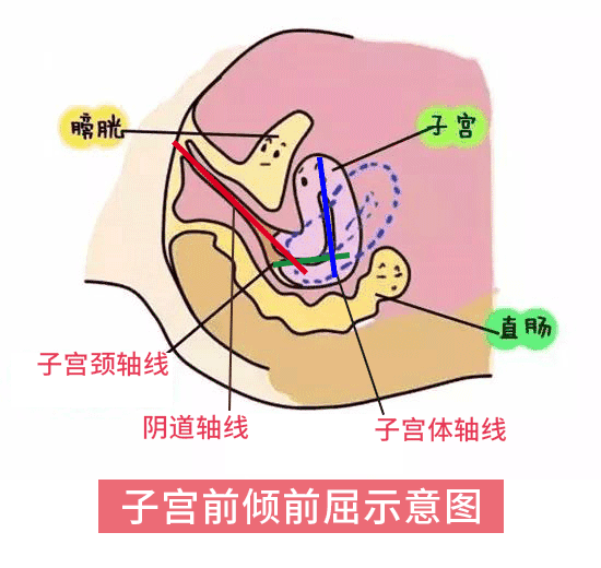 子宫前位与子宫后位,教你如何分清?