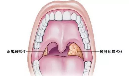 反复的扁桃体发炎,会导致人体经常性出现发烧,咽喉肿痛等.