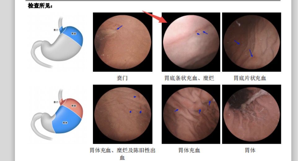 我的胃怎麼這樣了！31歲，我第一次做了胃鏡 健康 第6張