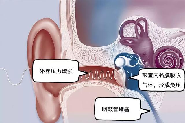 航空性中耳炎:云端下的听力杀手