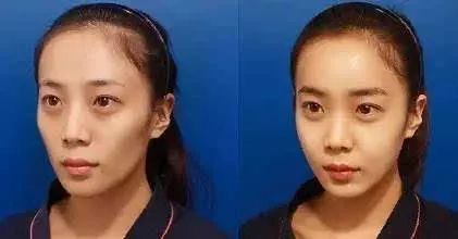 回春没多久的杨紫，咋又肿成这样了？