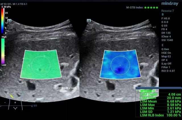 剪切波弹性成像:于细微处见真知