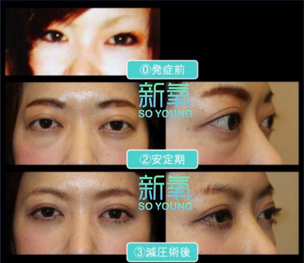 迷死氧日本亲身体验2，我用脖子上的皮给自己缝了毛孔