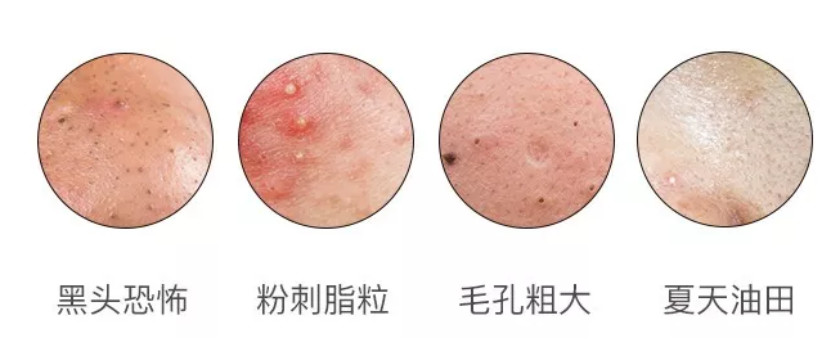 磨人的小妖精，看我怎么消灭你，它堪称黑头收割机，还能嫩肤美肤｜小话题
