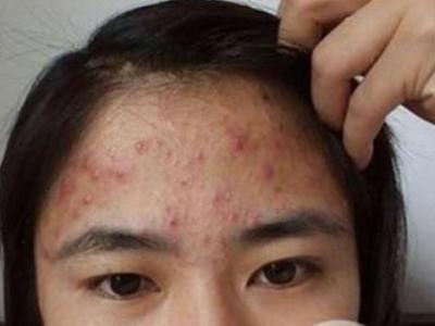 脸上脱皮瘙痒,粉刺,红斑等症状,螨虫还会引起毛囊炎,哮喘,过敏性皮炎