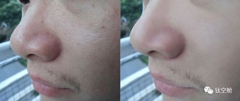 磨人的小妖精，看我怎么消灭你，它堪称黑头收割机，还能嫩肤美肤｜小话题