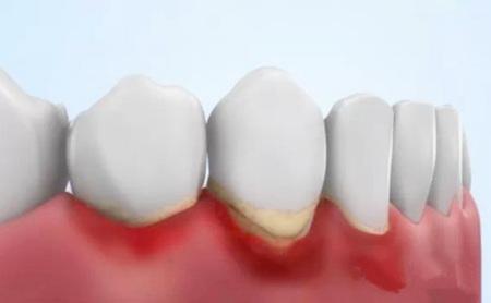 牙结石给口腔健康添加担负，怎么能防止它增多？
