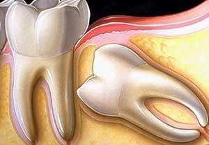 智齿不疼不痒正常生长,还需要拔吗?