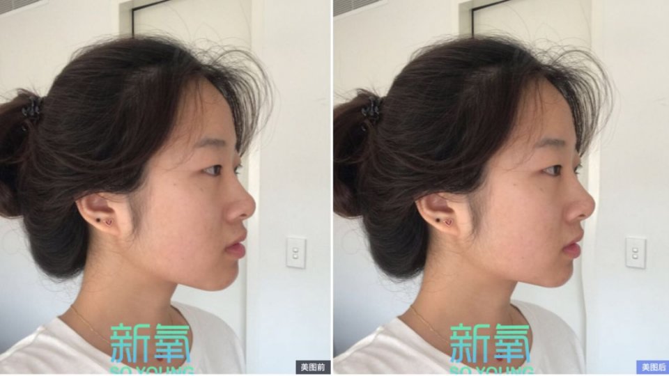 这些都是地包天的特征.