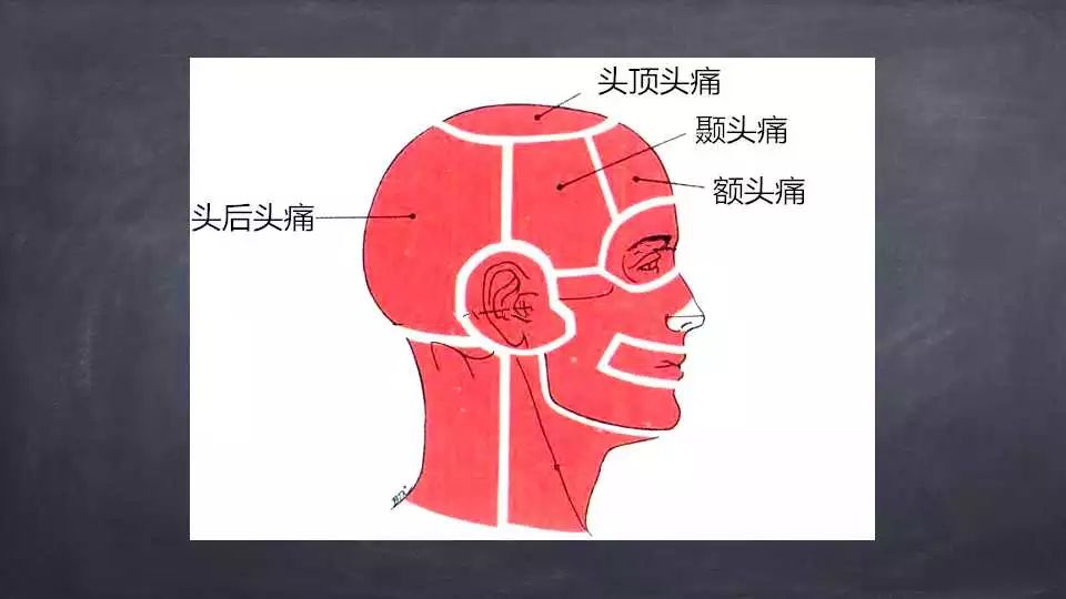 颈源性头痛如果按照疼痛区域来进行分类的话,那可以分为额头痛,头顶痛