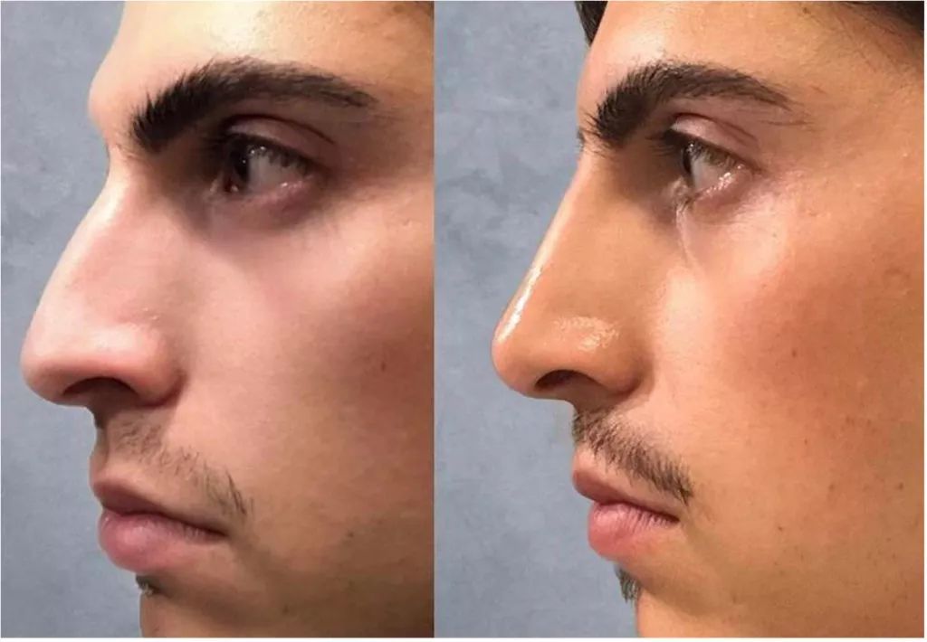 Is It Possible To Slim Your Nose Without Surgery Is It Possible To Slim Your Nose Without Surgery