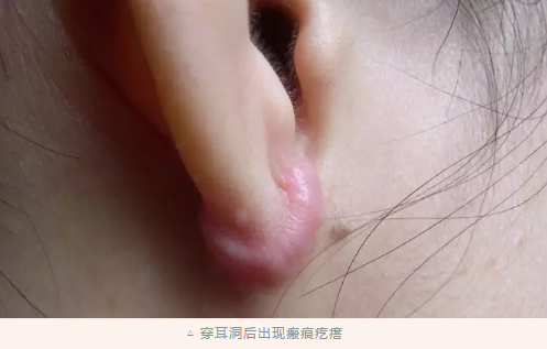 磕磕碰碰的人生,说说疤痕这些事儿 88明升