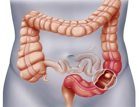 痔疮和息肉区别是什么?图片长的啥样子呢?