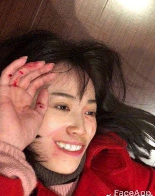 马蓉伤照被指摆拍，后被友人背着跑出院，网友：那我们来P图吧！
