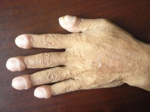 杵状指是指我们的十个手指都变粗,而且手指的主干部位不粗,只有指头