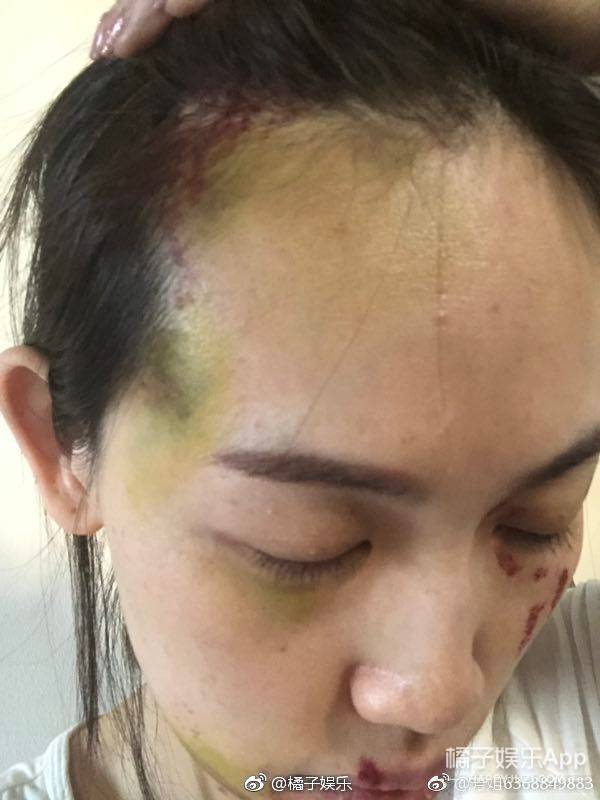 马蓉验伤报告曝光 邱晨自曝患癌