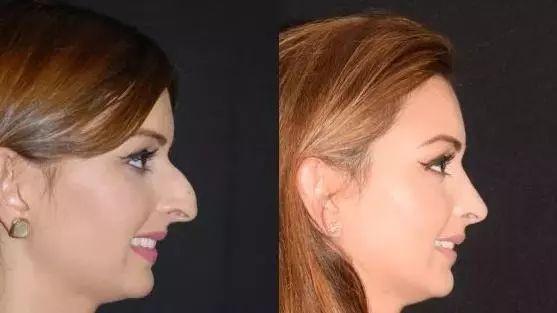 12岁整鼻到20岁还没拆绷带，只是为了炫富？