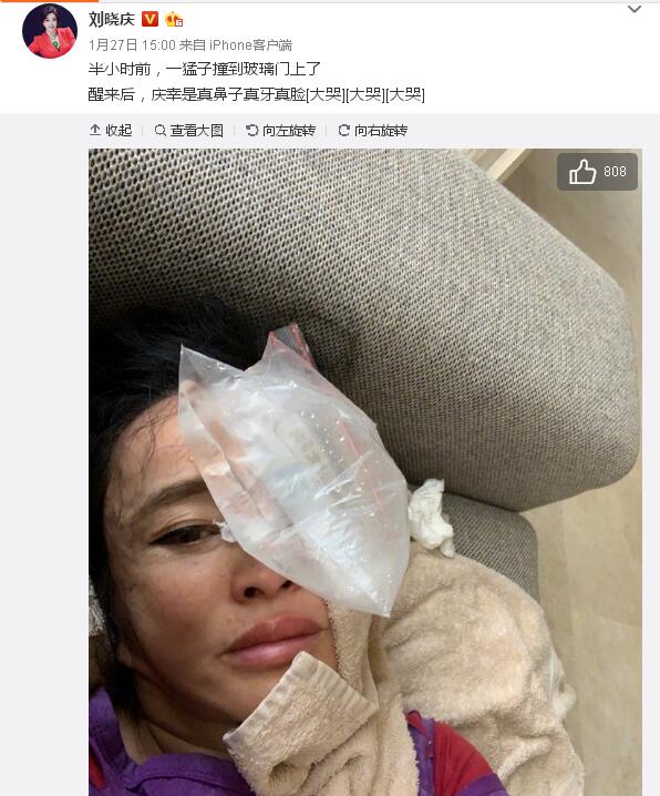 刘晓庆的脸猛撞上玻璃门，伤成这样还不忘自拍！