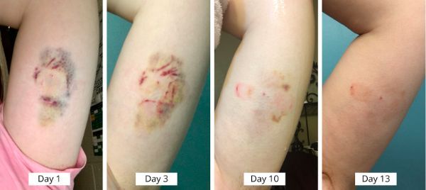 皮下埋植术后会出现淤青,但是数天后手术痕迹就会消失 / 网络