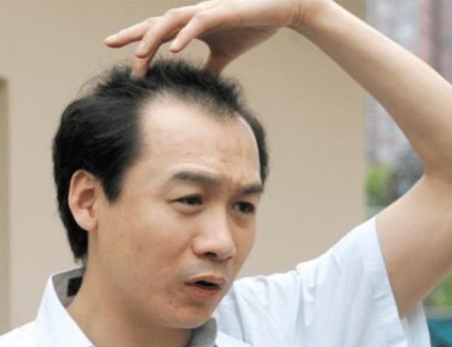 脱发来临前，头上出现的4个信号，别视而不见，要趁早注意