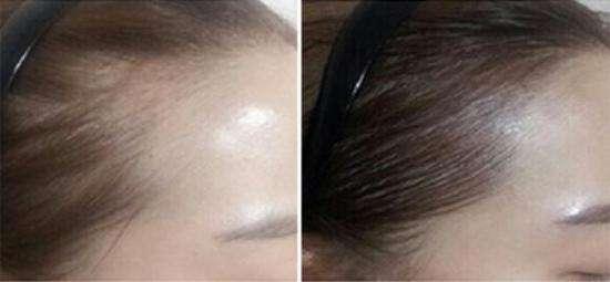 天生发际线高适合植发调整吗?北京发际线种植有用吗?