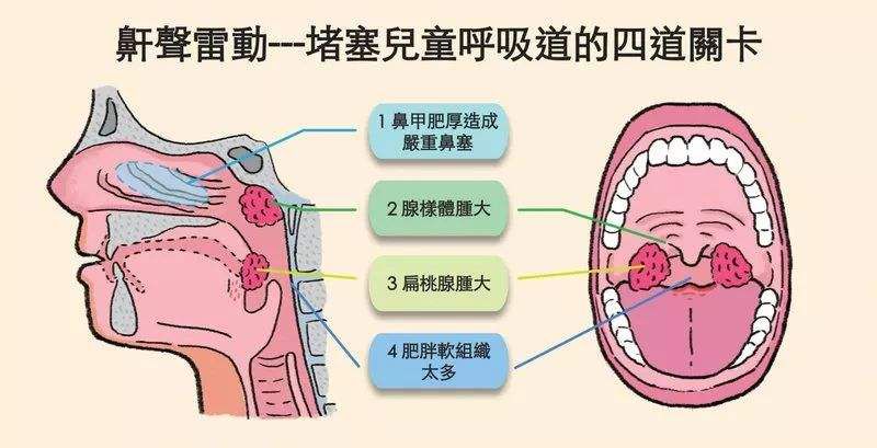 腺样体肥大——熟悉的病名,陌生的疾病