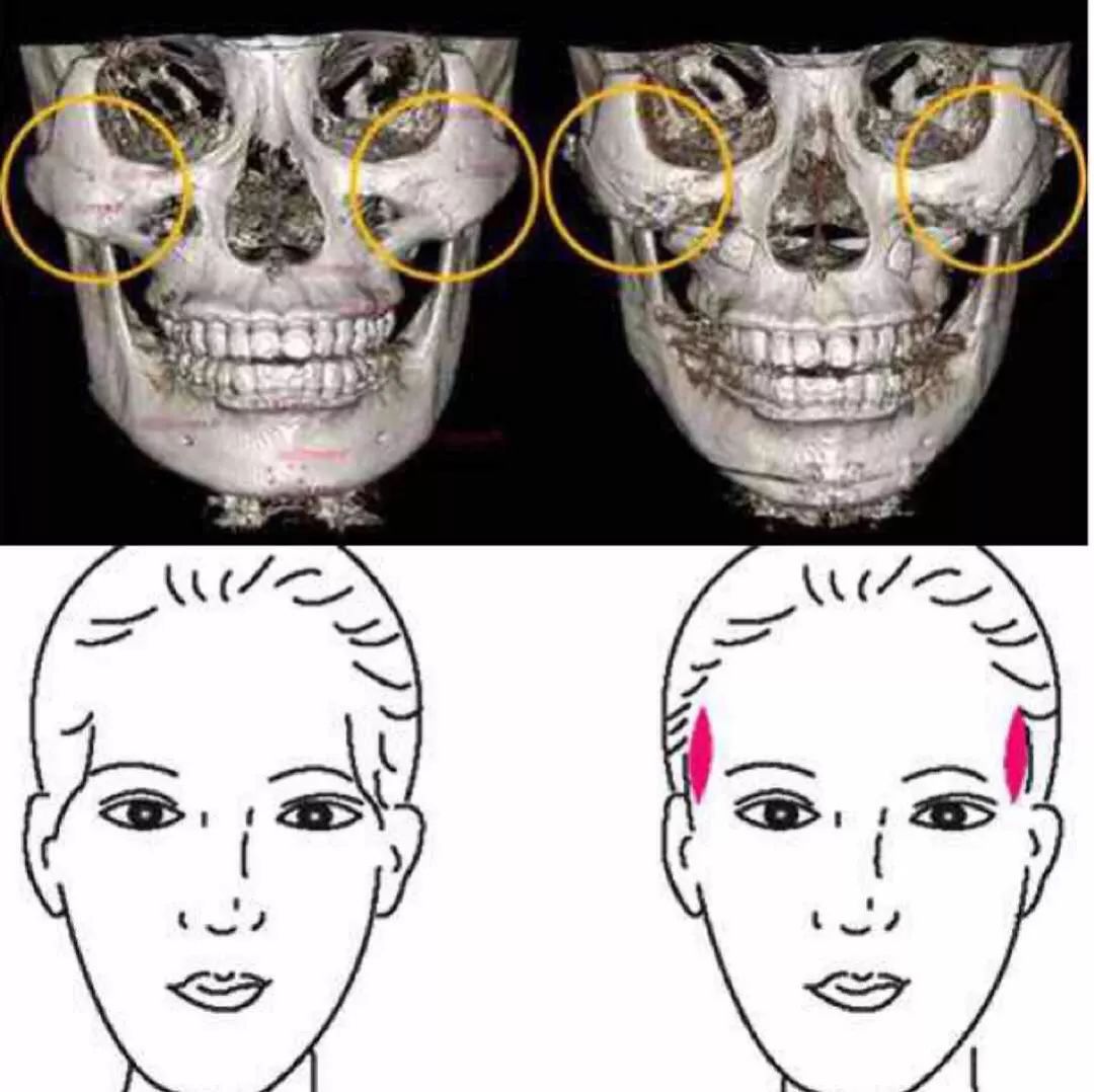 另外关于内轮廓线还有一个思路是在克制情况下将颧骨最高点往鼻子推