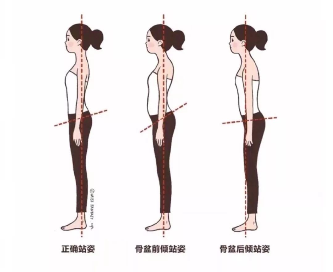 100个脊柱侧弯/姿势体态不正纠正案例分析（健行者真实案例，持续更新） - 知乎