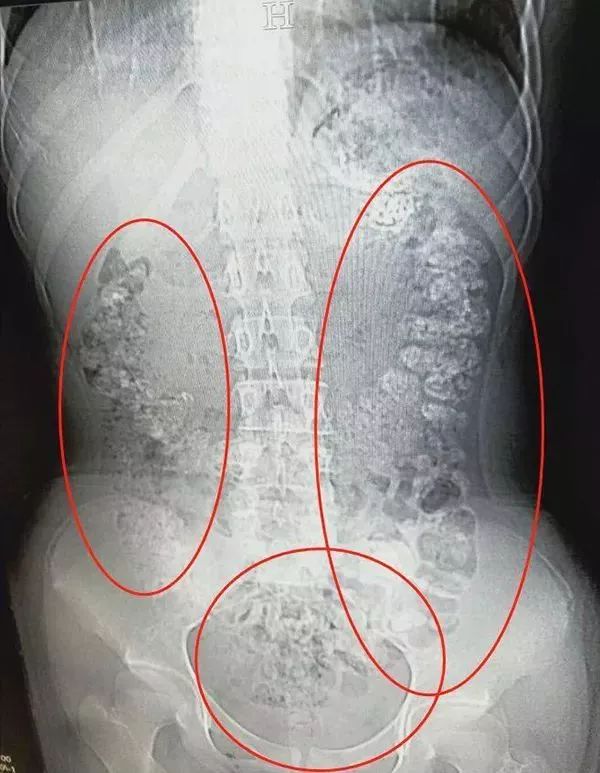 张楼炜见她肚子鼓鼓的,便安排了腹部ct,检查结果让他一惊:患者胃部