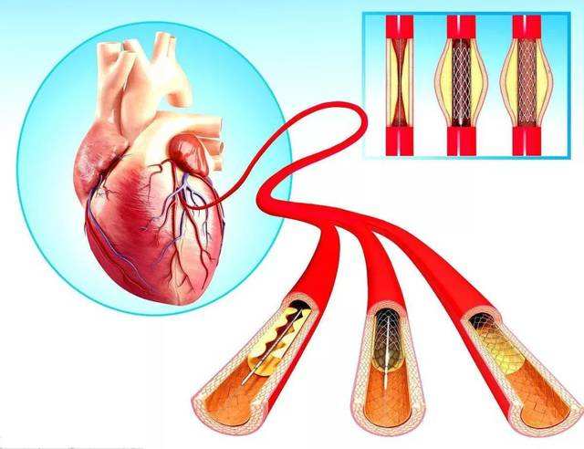 中国心脏支架手术因暴利被滥用?医生:支架远远不够