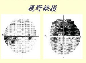 首大施玉英:视网膜脱落是一个很"凶险"的眼病