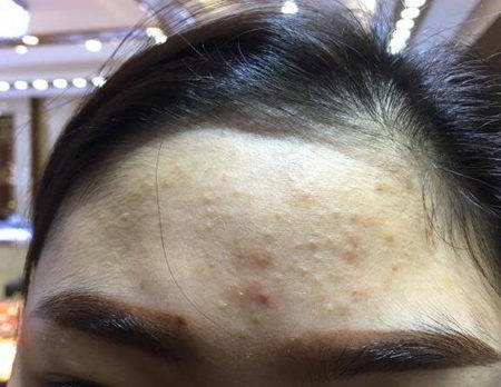 2)会导致营养堆积引发闭口痘痘和粉刺