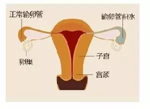 【试管知识】输卵管积水可以做试管婴儿吗__凤凰网