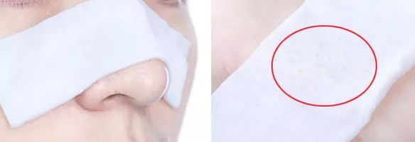 脸上黑头粉刺太多?千万别手贱去挤,用这个,黑