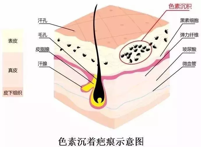 色素沉着是指在皮肤表皮的深层,有一种黑素细胞.