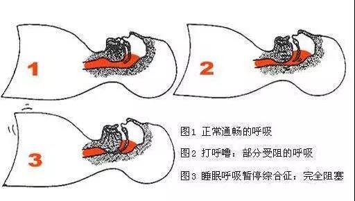 打呼噜分三种,前两种可以放心睡,第三种就必须